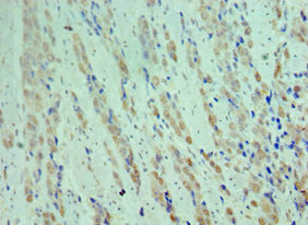 CDK9 Antibody - Immunohistochemistry of paraffin-embedded human colon cancer using CDK9 Antibody at dilution of 1:100