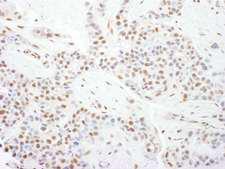 CDK9 Antibody - Detection of Human CDK9 by Immunohistochemistry. Sample: FFPE section of human breast carcinoma. Antibody: Affinity purified rabbit anti-CDK9 used at a dilution of 1:200 (1 ug/ml). Detection: DAB.
