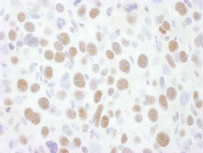 CDK9 Antibody - Detection of Mouse CDK9 by Immunohistochemistry. Sample: FFPE section of mouse renal cell carcinoma. Antibody: Affinity purified rabbit anti-CDK9 used at a dilution of 1:200 (1 ug/ml). Detection: DAB.
