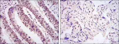 CDK9 Antibody - IHC of paraffin-embedded rectum cancer tissues (left) and placenta tissues (right) using CDK9 mouse monoclonal antibody with DAB staining.