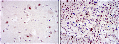 CDK9 Antibody - IHC of paraffin-embedded brain tissues (left) and esophageal cancer tissues (right) using CDK9 mouse monoclonal antibody with DAB staining.
