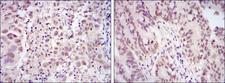 CDK9 Antibody - IHC of paraffin-embedded endometrial cancer tissues (left) and rectum cancer tissues (right) using CDK9 mouse monoclonal antibody with DAB staining.