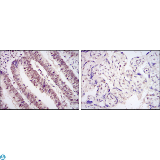 CDK9 Antibody - Immunohistochemistry (IHC) analysis of paraffin-embedded rectum cancer tissues (left) and placenta tissues (right) with DAB staining using Cdk9 Monoclonal Antibody.