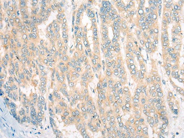 CDKAL1 Antibody - Immunohistochemistry of paraffin-embedded Human liver cancer tissue  using CDKAL1 Polyclonal Antibody at dilution of 1:60(×200)