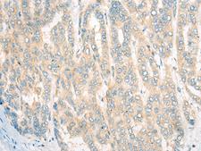 CDKAL1 Antibody - Immunohistochemistry of paraffin-embedded Human liver cancer tissue  using CDKAL1 Polyclonal Antibody at dilution of 1:60(×200)