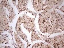 CDKL1 Antibody - Immunohistochemical staining of paraffin-embedded Carcinoma of Human prostate tissue using anti-CDKL1 mouse monoclonal antibody.  heat-induced epitope retrieval by 1 mM EDTA in 10mM Tris, pH8.5, 120C for 3min)