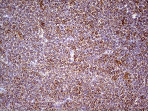 CDKL1 Antibody - Immunohistochemical staining of paraffin-embedded Human lymphoma tissue using anti-CDKL1 mouse monoclonal antibody.  heat-induced epitope retrieval by 1 mM EDTA in 10mM Tris, pH8.5, 120C for 3min)