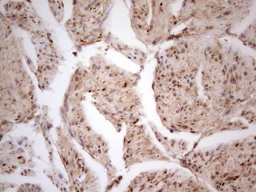 CDKL1 Antibody - IHC of paraffin-embedded Carcinoma of Human prostate tissue using anti-CDKL1 mouse monoclonal antibody. (heat-induced epitope retrieval by 1 mM EDTA in 10mM Tris, pH8.5, 120°C for 3min).