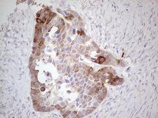 CDKL1 Antibody - IHC of paraffin-embedded Carcinoma of Human kidney tissue using anti-CDKL1 mouse monoclonal antibody. (Heat-induced epitope retrieval by 1 mM EDTA in 10mM Tris, pH8.5, 120°C for 3min).