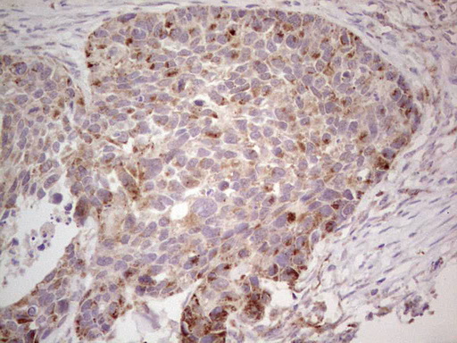 CDKL1 Antibody - Immunohistochemical staining of paraffin-embedded Carcinoma of Human kidney tissue using anti-CDKL1 mouse monoclonal antibody. (Heat-induced epitope retrieval by 1 mM EDTA in 10mM Tris, pH8.5, 120C for 3min,