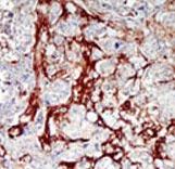 CDKL1 Antibody - Formalin-fixed and paraffin-embedded human cancer tissue reacted with the primary antibody, which was peroxidase-conjugated to the secondary antibody, followed by DAB staining. This data demonstrates the use of this antibody for immunohistochemistry; clinical relevance has not been evaluated. BC = breast carcinoma; HC = hepatocarcinoma.