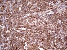 CDKL2 Antibody - Immunohistochemical staining of paraffin-embedded Carcinoma of Human lung tissue using anti-CDKL2 mouse monoclonal antibody. (Heat-induced epitope retrieval by 1 mM EDTA in 10mM Tris, pH8.5, 120C for 3min,