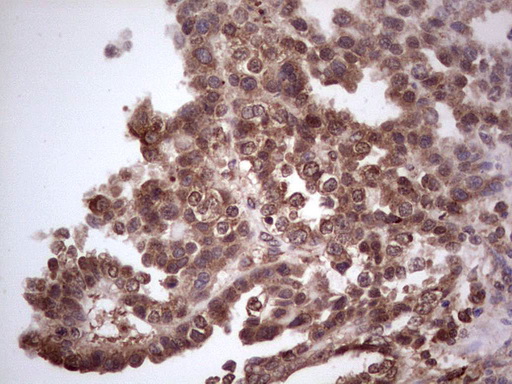 CDKL2 Antibody - Immunohistochemical staining of paraffin-embedded Adenocarcinoma of Human ovary tissue using anti-CDKL2 mouse monoclonal antibody. (Heat-induced epitope retrieval by 1 mM EDTA in 10mM Tris, pH8.5, 120C for 3min,
