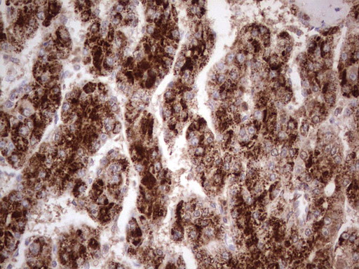 CDKL2 Antibody - Immunohistochemical staining of paraffin-embedded Carcinoma of Human liver tissue using anti-CDKL2 mouse monoclonal antibody. (Heat-induced epitope retrieval by 1 mM EDTA in 10mM Tris, pH8.5, 120C for 3min,