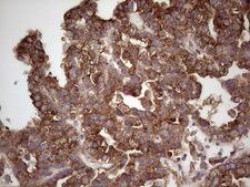 CDKL2 Antibody - Immunohistochemical staining of paraffin-embedded Adenocarcinoma of Human ovary tissue using anti-CDKL2 mouse monoclonal antibody. (Heat-induced epitope retrieval by 1 mM EDTA in 10mM Tris, pH8.5, 120C for 3min,