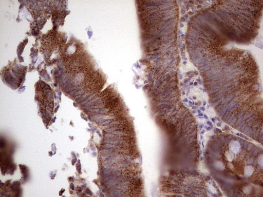 CDKL2 Antibody - Immunohistochemical staining of paraffin-embedded Adenocarcinoma of Human colon tissue using anti-CDKL2 mouse monoclonal antibody. (Heat-induced epitope retrieval by 1 mM EDTA in 10mM Tris, pH8.5, 120C for 3min,