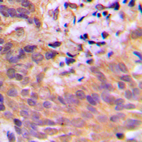 CDKL2 Antibody - Immunohistochemical analysis of CDKL2 staining in human breast cancer formalin fixed paraffin embedded tissue section. The section was pre-treated using heat mediated antigen retrieval with sodium citrate buffer (pH 6.0). The section was then incubated with the antibody at room temperature and detected using an HRP conjugated compact polymer system. DAB was used as the chromogen. The section was then counterstained with hematoxylin and mounted with DPX.