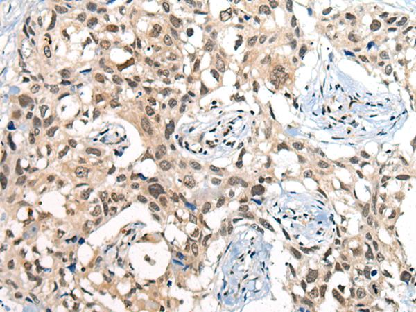 CDKL2 Antibody - Immunohistochemistry of paraffin-embedded Human lung cancer tissue  using CDKL2 Polyclonal Antibody at dilution of 1:25(×200)