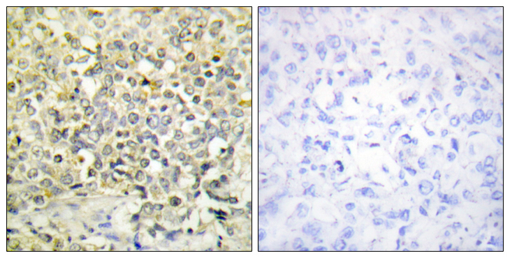 CDKL4 Antibody - Immunohistochemistry analysis of paraffin-embedded human lung carcinoma tissue, using CDKL4 Antibody. The picture on the right is blocked with the synthesized peptide.
