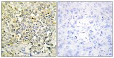 CDKL4 Antibody - Immunohistochemistry analysis of paraffin-embedded human lung carcinoma tissue, using CDKL4 Antibody. The picture on the right is blocked with the synthesized peptide.