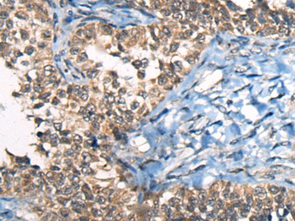CDKL4 Antibody - Immunohistochemistry of paraffin-embedded Human ovarian cancer tissue  using CDKL4 Polyclonal Antibody at dilution of 1:45(×200)