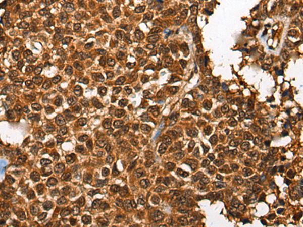CDKL4 Antibody - Immunohistochemistry of paraffin-embedded Human ovarian cancer tissue  using CDKL4 Polyclonal Antibody at dilution of 1:35(×200)