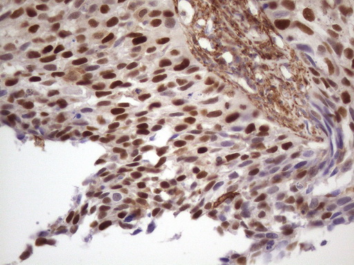 CDKN1A / WAF1 / p21 Antibody - IHC of paraffin-embedded Carcinoma of Human kidney tissue using anti-CDKN1A mouse monoclonal antibody. (Heat-induced epitope retrieval by 1 mM EDTA in 10mM Tris, pH8.5, 120°C for 3min)(1:150).
