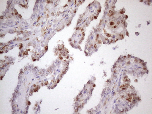 CDKN1A / WAF1 / p21 Antibody - IHC of paraffin-embedded Carcinoma of Human thyroid tissue using anti-CDKN1A mouse monoclonal antibody. (Heat-induced epitope retrieval by 1 mM EDTA in 10mM Tris, pH8.5, 120°C for 3min)(1:150).