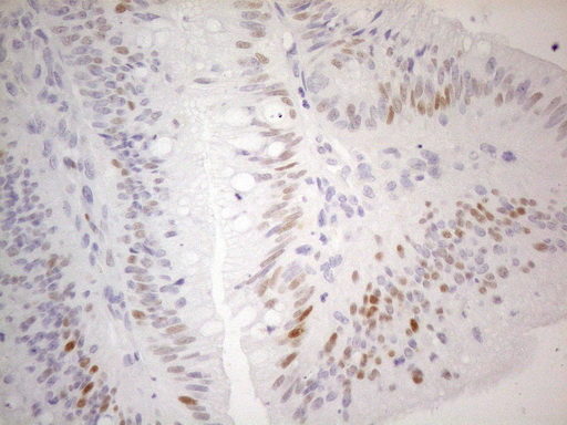 CDKN1A / WAF1 / p21 Antibody - Immunohistochemical staining of paraffin-embedded Carcinoma of Human pancreas tissue using anti-CDKN1A mouse monoclonal antibody. (Heat-induced epitope retrieval by 1mM EDTA in 10mM Tris buffer. (pH8.5) at 120°C for 3 min. (1:150)