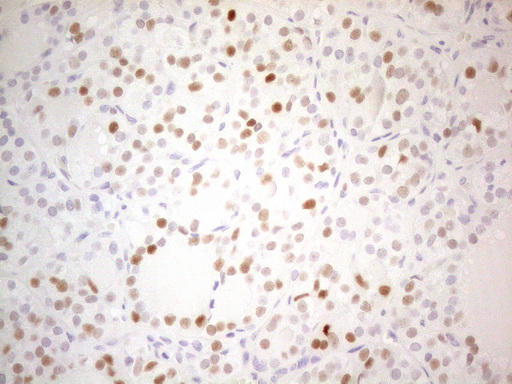 CDKN1A / WAF1 / p21 Antibody - Immunohistochemical staining of paraffin-embedded Human thyroid tissue using anti-CDKN1A mouse monoclonal antibody. (Heat-induced epitope retrieval by 1mM EDTA in 10mM Tris buffer. (pH8.5) at 120°C for 3 min. (1:150)