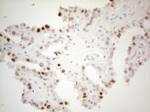 CDKN1A / WAF1 / p21 Antibody - Immunohistochemical staining of paraffin-embedded Carcinoma of Human thyroid tissue using anti-CDKN1A mouse monoclonal antibody. (Heat-induced epitope retrieval by 1mM EDTA in 10mM Tris buffer. (pH8.5) at 120°C for 3 min. (1:150)