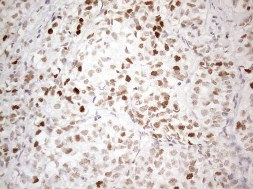 CDKN1A / WAF1 / p21 Antibody - Immunohistochemical staining of paraffin-embedded Adenocarcinoma of Human endometrium tissue using anti-CDKN1A mouse monoclonal antibody. (Heat-induced epitope retrieval by 1mM EDTA in 10mM Tris buffer. (pH8.5) at 120°C for 3 min. (1:150)