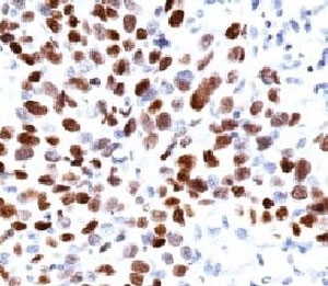 CDKN1A / WAF1 / p21 Antibody - Formalin-fixed, paraffin-embedded human lung squamous cell carcinoma (SCC) stained with p21 antibody (CIP1/823).  This image was taken for the unmodified form of this product. Other forms have not been tested.