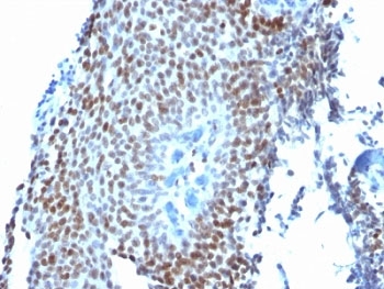 CDKN1A / WAF1 / p21 Antibody - Formalin-fixed, paraffin-embedded human bladder carcinoma stained with p21 antibody (CIP1/823).  This image was taken for the unmodified form of this product. Other forms have not been tested.