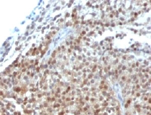 CDKN1A / WAF1 / p21 Antibody - Formalin-fixed, paraffin-embedded human bladder carcinoma stained with p21 antibody (CIP1/823 + DCS-60.2).  This image was taken for the unmodified form of this product. Other forms have not been tested.
