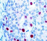 CDKN1A / WAF1 / p21 Antibody - IHC of p21 on FFPE Colon Carcinoma tissue.