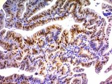 CDKN1A / WAF1 / p21 Antibody - Formalin-fixed, paraffin-embedded human colon carcinoma stained with p21 antibody (DCS-60.2).  This image was taken for the unmodified form of this product. Other forms have not been tested.