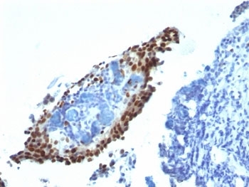 CDKN1A / WAF1 / p21 Antibody - Formalin-fixed, paraffin-embedded bladder carcinoma stained with p21 antibody (HJ21).  This image was taken for the unmodified form of this product. Other forms have not been tested.
