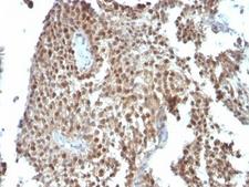 CDKN1A / WAF1 / p21 Antibody - Formalin-fixed, paraffin-embedded human colon carcinoma stained with anti-p21 antibody (SPM306).  This image was taken for the unmodified form of this product. Other forms have not been tested.