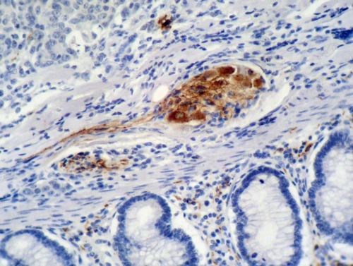 CDKN1A / WAF1 / p21 Antibody - Immunohistochemistry staining of colon carcinoma (paraffin-embedded sections) with anti-p21 (WA-1).