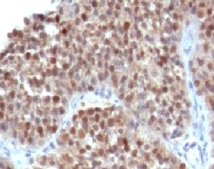 CDKN1A / WAF1 / p21 Antibody - IHC testing of human bladder carcinoma and p21 antibody (WAF21-1).  This image was taken for the unmodified form of this product. Other forms have not been tested.