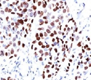 CDKN1A / WAF1 / p21 Antibody - IHC testing of human lung squamous cell carcinoma (SCC) and p21 antibody (WAF21-1).  This image was taken for the unmodified form of this product. Other forms have not been tested.