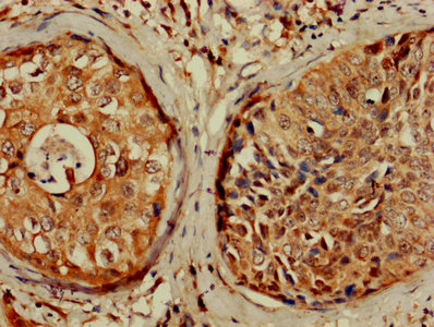 CDKN1A / WAF1 / p21 Antibody - IHC image of Rabbit anti-Human Cyclin-dependent kinase inhibitor 1 polyclonal Antibody diluted at 1:1200 and staining in paraffin-embedded human cervical cancer performed on a Leica BondTM system. After dewaxing and hydration, antigen retrieval was mediated by high pressure in a citrate buffer (pH 6.0). Section was blocked with 10% normal goat serum 30min at RT. Then primary antibody (1% BSA) was incubated at 4°C overnight. The primary is detected by a biotinylated secondary antibody and visualized using an HRP conjugated SP system.