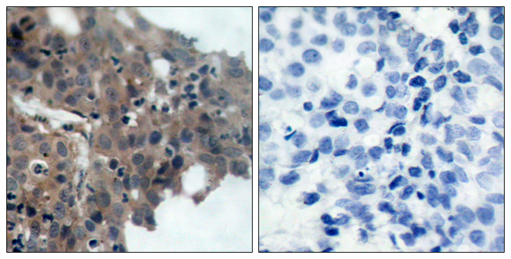 CDKN1A / WAF1 / p21 Antibody - Immunohistochemistry analysis of paraffin-embedded human breast carcinoma, using p21 Cip1 (Phospho-Thr145) Antibody. The picture on the right is blocked with the phospho peptide.