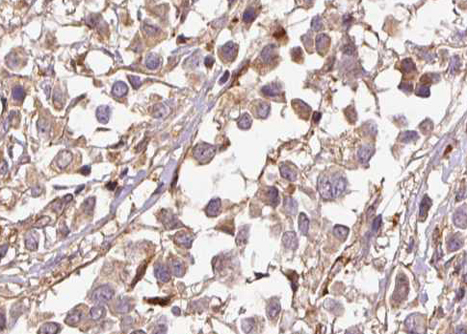 CDKN1A / WAF1 / p21 Antibody - 1:100 staining human breast carcinoma tissue by IHC-P. The tissue was formaldehyde fixed and a heat mediated antigen retrieval step in citrate buffer was performed. The tissue was then blocked and incubated with the antibody for 1.5 hours at 22°C. An HRP conjugated goat anti-rabbit antibody was used as the secondary.