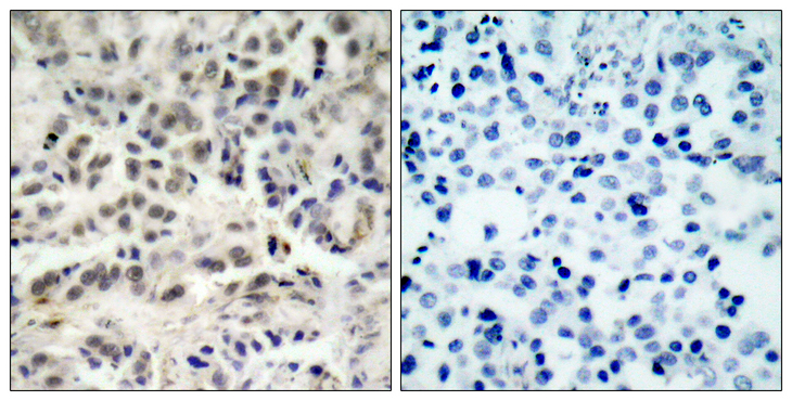 CDKN1B / p27 Kip1 Antibody - Immunohistochemistry analysis of paraffin-embedded human lung carcinoma tissue, using p27 Kip1 Antibody. The picture on the right is blocked with the synthesized peptide.