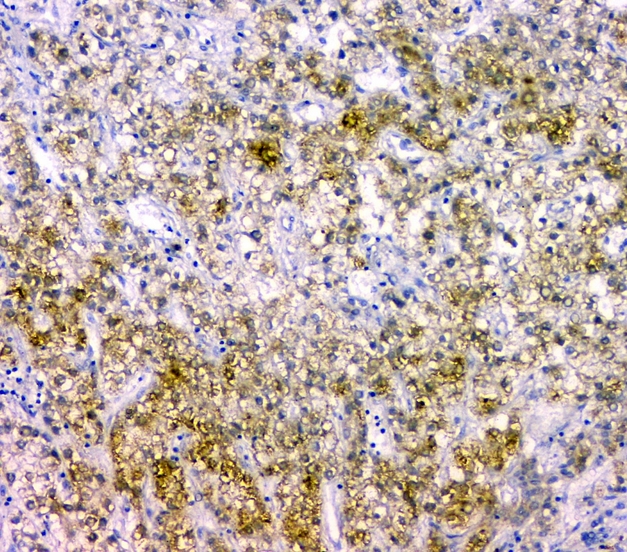 CDKN1B / p27 Kip1 Antibody - IHC analysis of p27 KIP 1 using anti-p27 KIP 1 antibody. p27 KIP 1 was detected in paraffin-embedded section of human liver cancer tissues. Heat mediated antigen retrieval was performed in citrate buffer (pH6, epitope retrieval solution) for 20 mins. The tissue section was blocked with 10% goat serum. The tissue section was then incubated with 1µg/ml rabbit anti-p27 KIP 1 Antibody overnight at 4°C. Biotinylated goat anti-rabbit IgG was used as secondary antibody and incubated for 30 minutes at 37°C. The tissue section was developed using Strepavidin-Biotin-Complex (SABC) with DAB as the chromogen.
