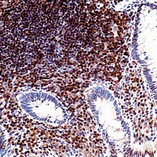 CDKN1B / p27 Kip1 Antibody - Formalin-fixed, paraffin-embedded human colon carcinoma stained with p27Kip1 antibody.