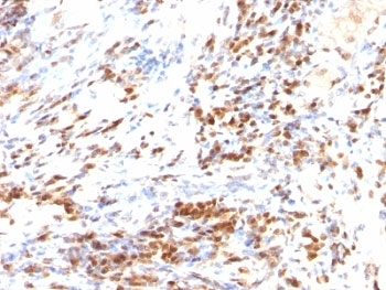CDKN1B / p27 Kip1 Antibody - Formalin-fixed, paraffin-embedded human colon carcinoma stained with p27 antibody (DCS-72.F6 + KIP1/769).  This image was taken for the unmodified form of this product. Other forms have not been tested.