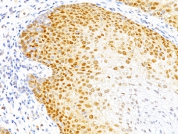 CDKN1B / p27 Kip1 Antibody - Formalin-fixed, paraffin-embedded human cervical cancer stained with p27 antibody (DCS-72.F6).  This image was taken for the unmodified form of this product. Other forms have not been tested.